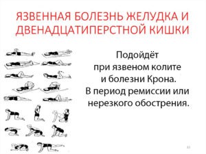ЛФК при язвенном колите ЛФК при язвенном колите
