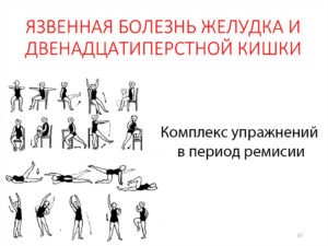 ЛФК при язвенном колите и болезни Крона ЛФК при язвенном колите и болезни Крона